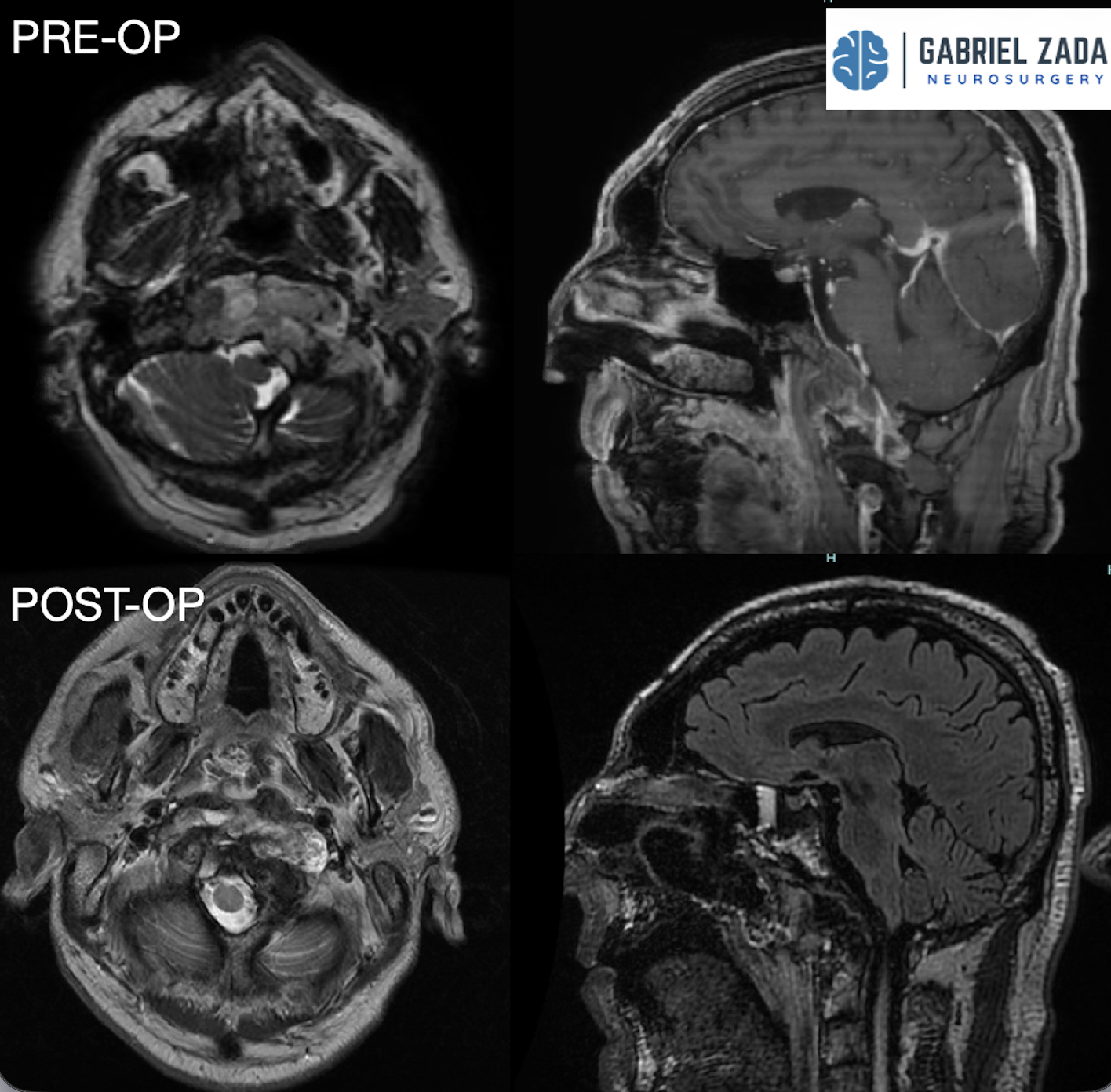 Chordoma surgery treatment
