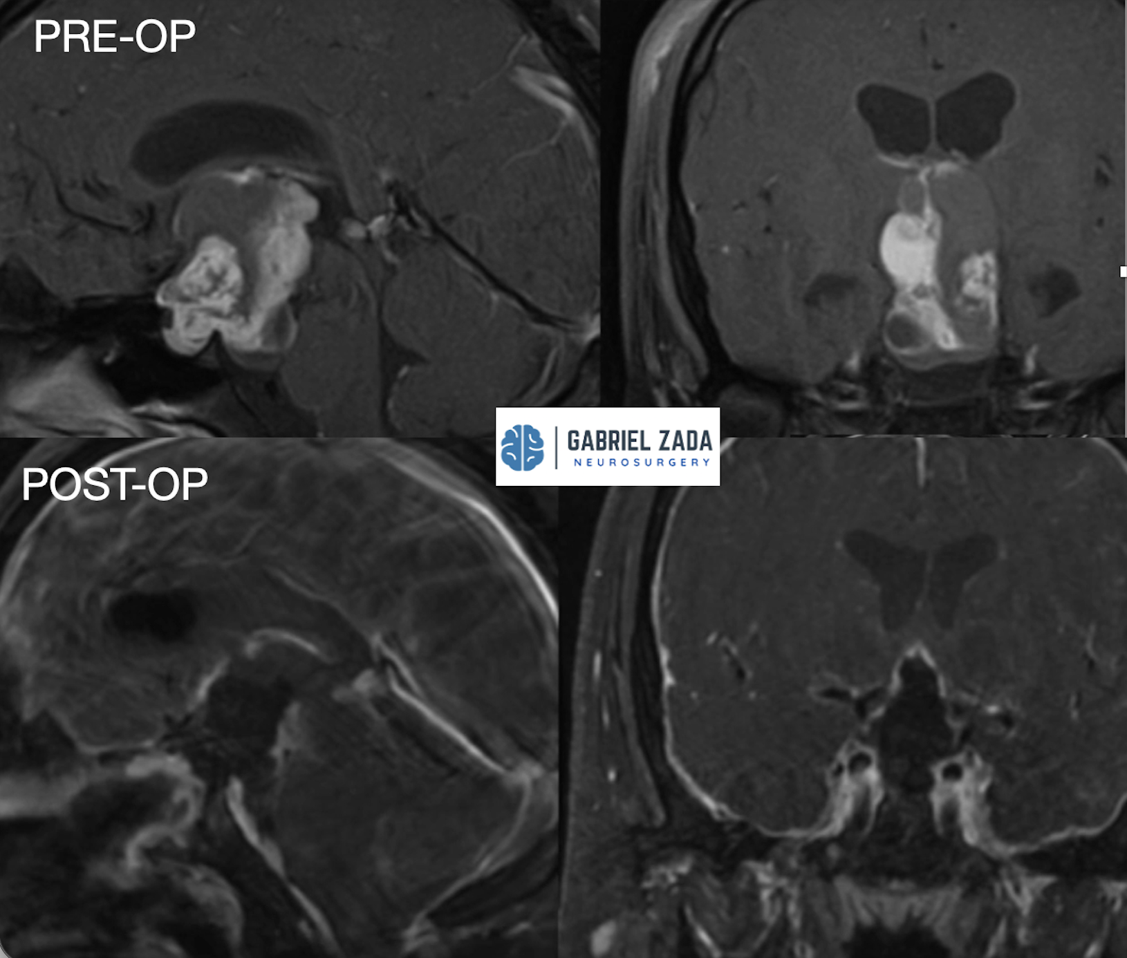 Craniopharyngioma treatment