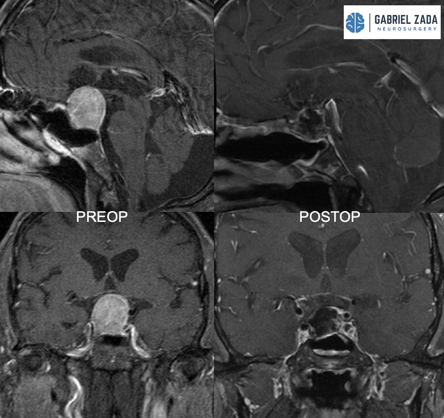 Pituitary tumor surgery