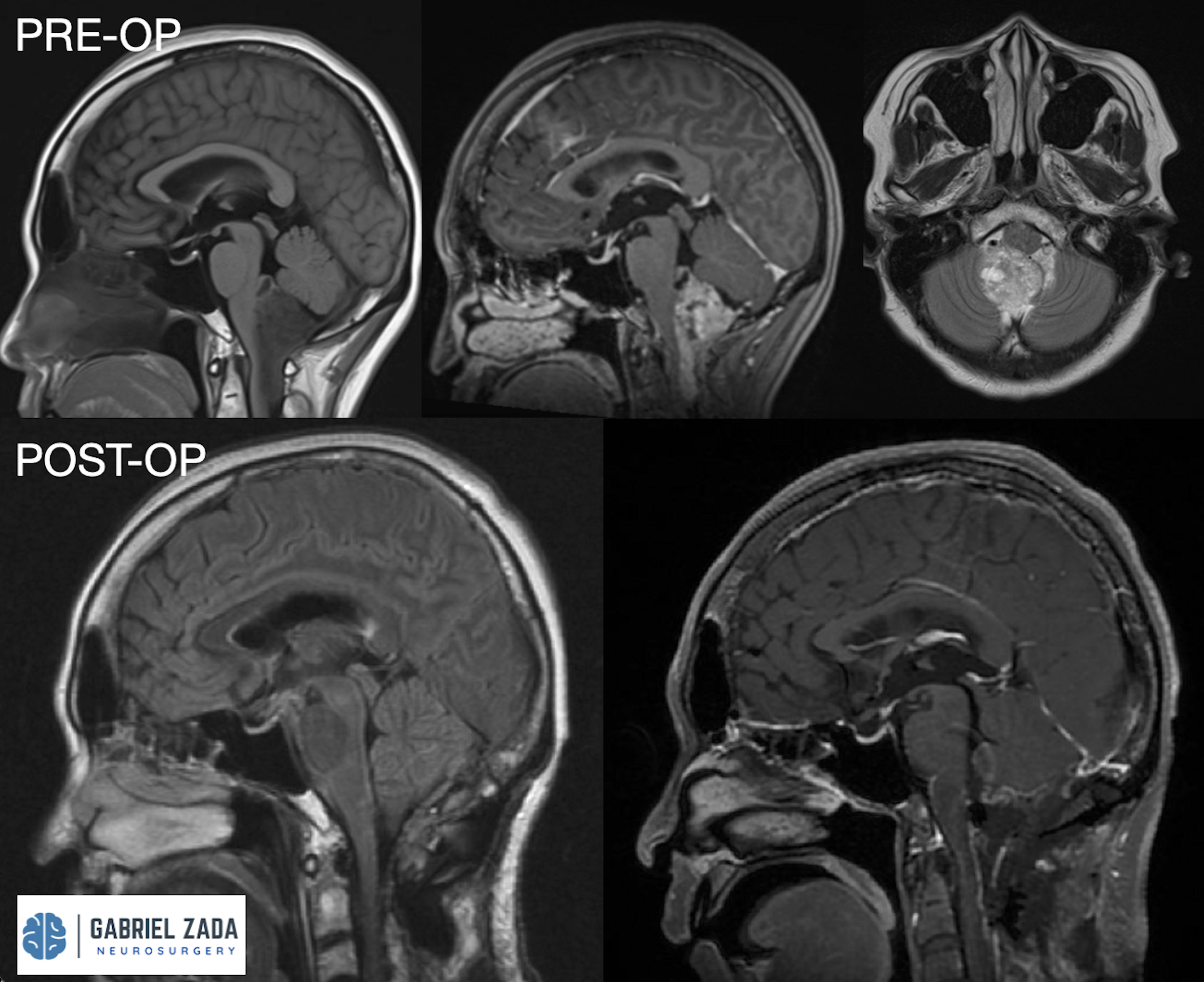 EPENDYMOMA.png