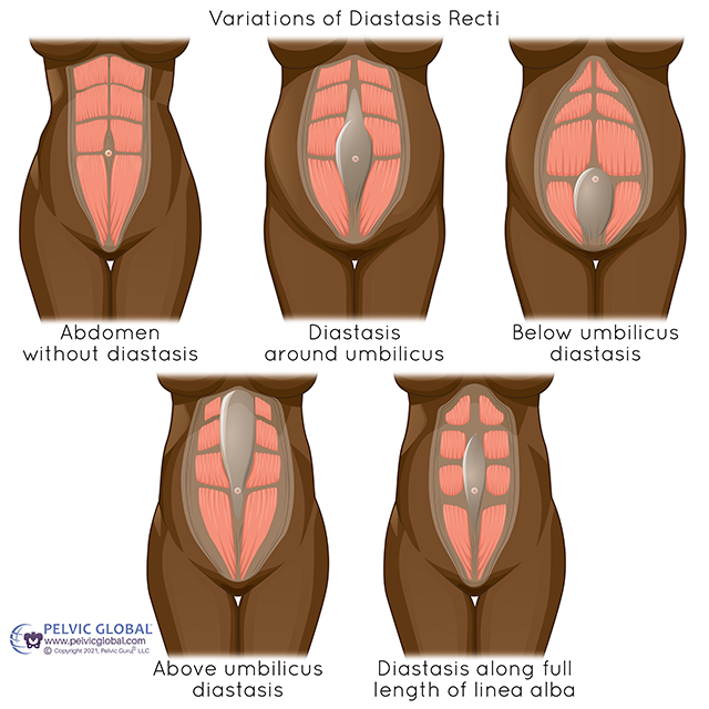 Diastasis Recti durham pelvic floor pt