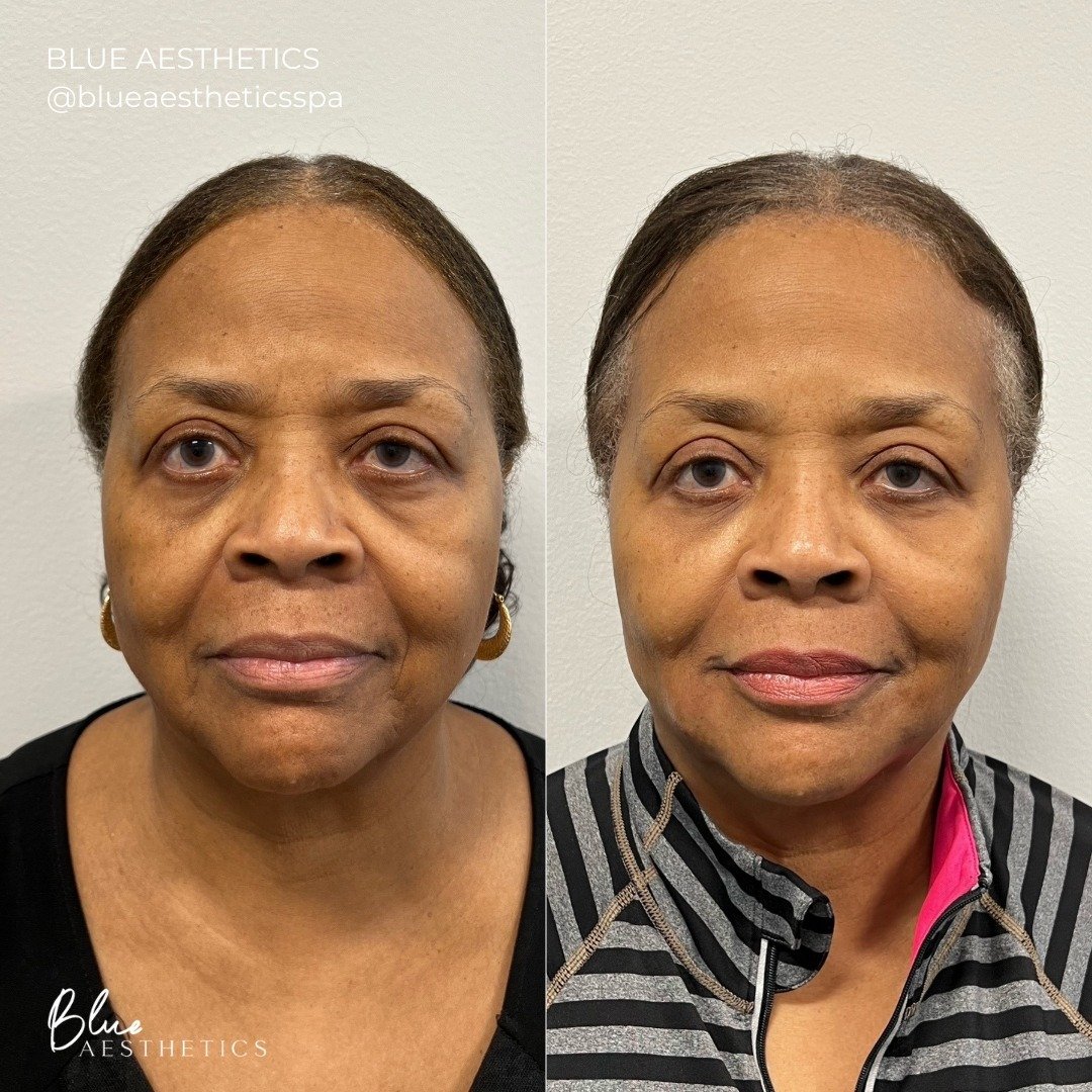 Filling is truly an art form! 🖼 The hollow concaves on our faces (which can develop overtime with aging) can cast shadows on your overall complexion! This is why you might feel like you look tired or haggard because this volume loss can bring out fi