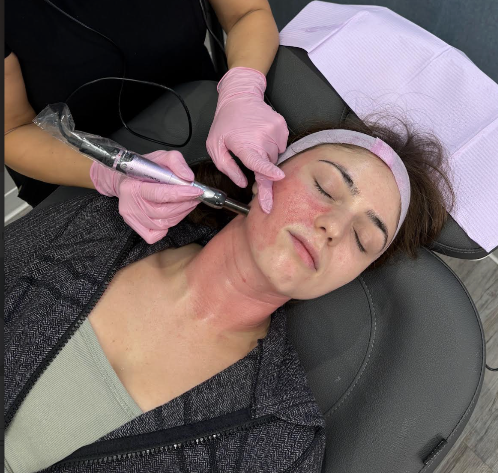 A woman receiving a facial treatment with a laser device on her cheek while lying down with a headband to expose her face.