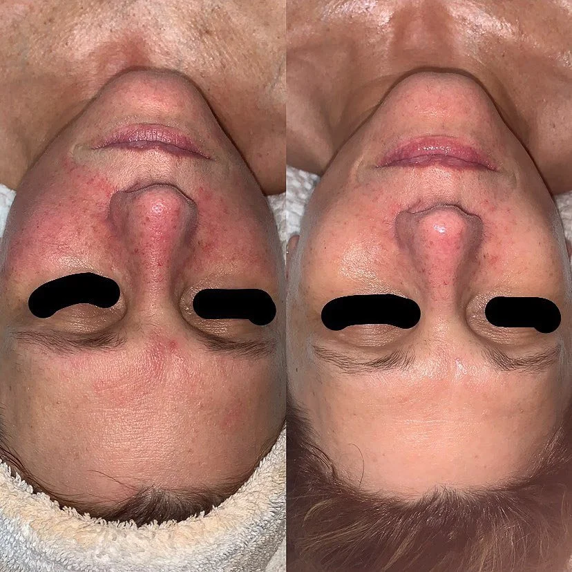 redness-improvement-skincare-before-and-after