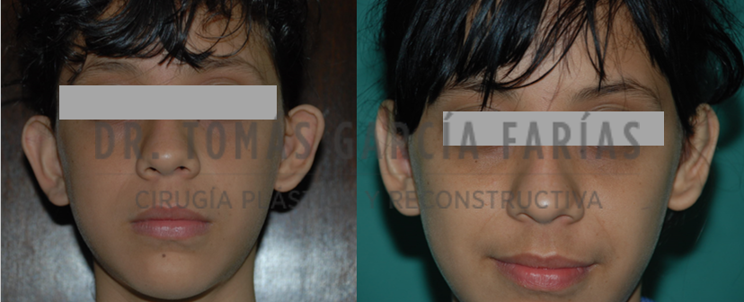 CIRUGÍA DE OREJAS (OTOPLASTIA) — Dr. Tomás García Farías