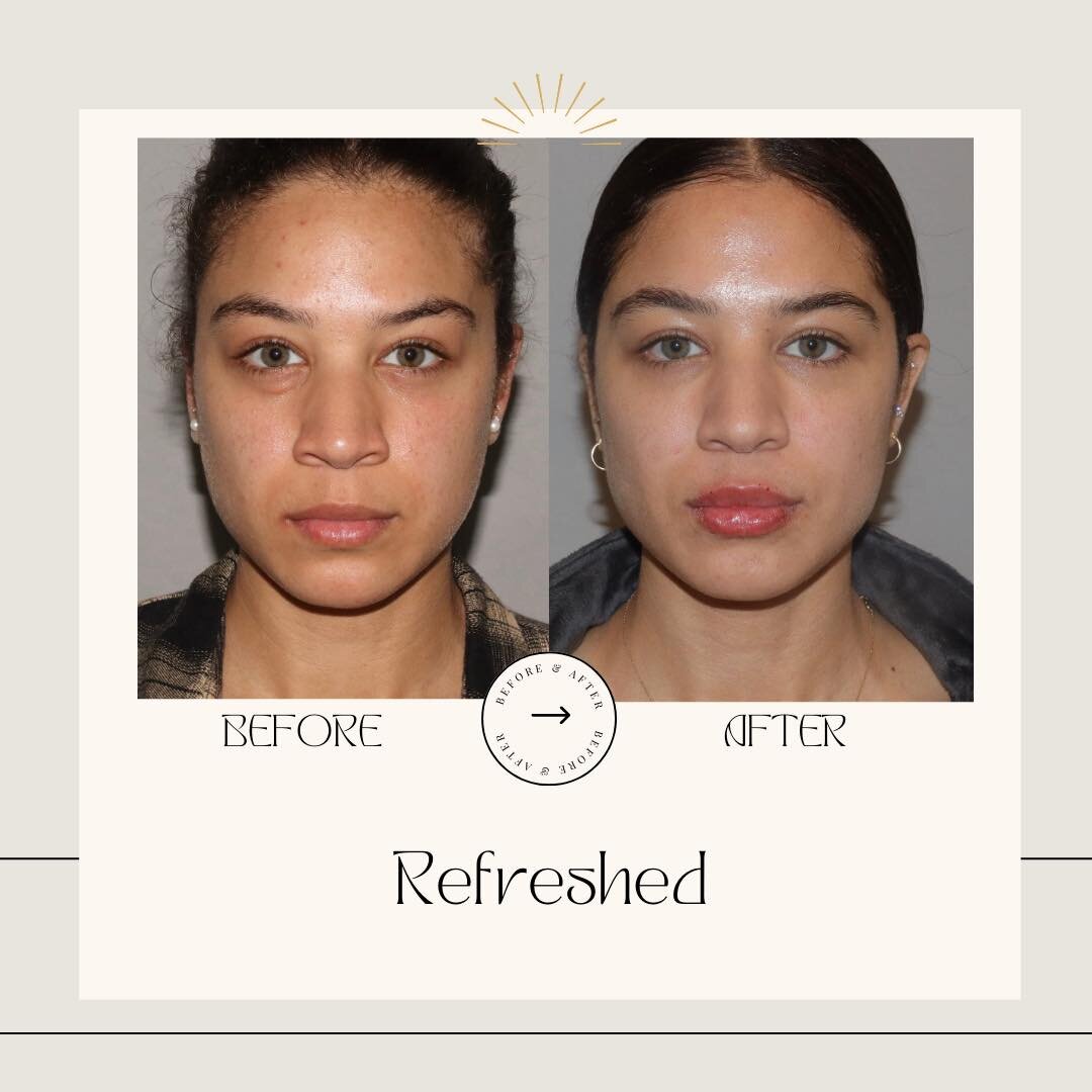 This patient needed a few minor touches to enhance the natural beauty she already has! She had two sessions of lateral brow PDO barbed threads to lift her brows and under eye filler to correct under eye hollowness(1/2 syringe each session). She also 