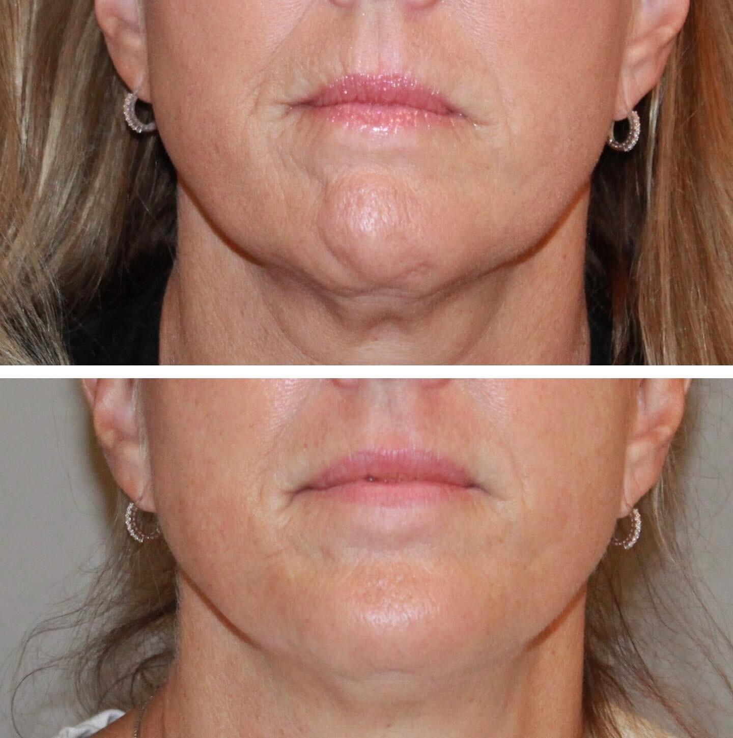 Genuinely impressed by the power of well placed neurotoxin! In this case, 13 units of #Dysport were used to relax her chin and lip border 💋 &hearts;️💉#beforeandafter  #botox #galderma #revance #allergan #beautybybridgetrn #injectables #estheticglow