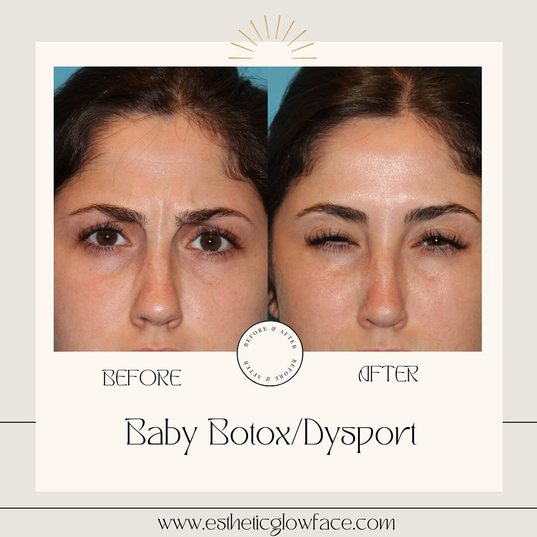 Sometimes it only takes a smidge of Botox/Dysport to do the trick!! This patient is in her early 20s but wanted some preventative baby tox to prevent permanent lines and to give her a nice lift in her brows￼! 
Schedule your treatment today with onlin