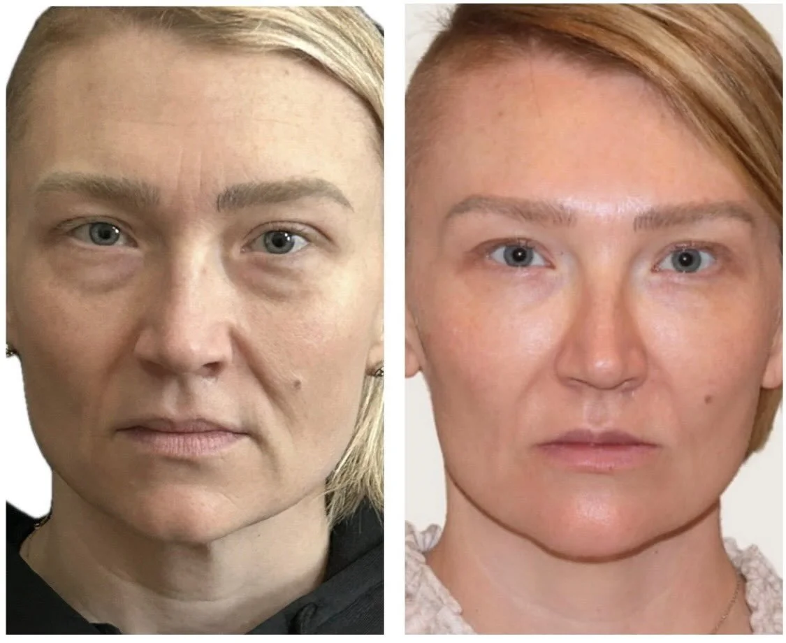 Snatched from every angle 💉Jawline, chin, lips, cheeks, and a full-face refresh with Dysport&mdash;this glow-up is next level. Balanced, lifted, and flawlessly refined. #FacialBalancing #EllijayMedspa #EllijayInjectables
