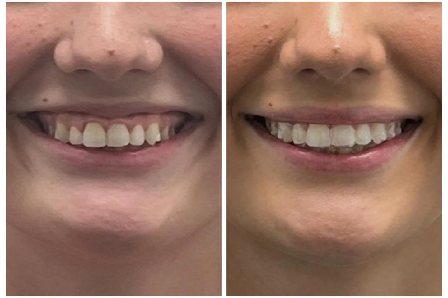 Bye gummy smile! Isn&rsquo;t it incredible what only 12 units of Dysport can do?! #dysport #botox #medspa #gummysmile