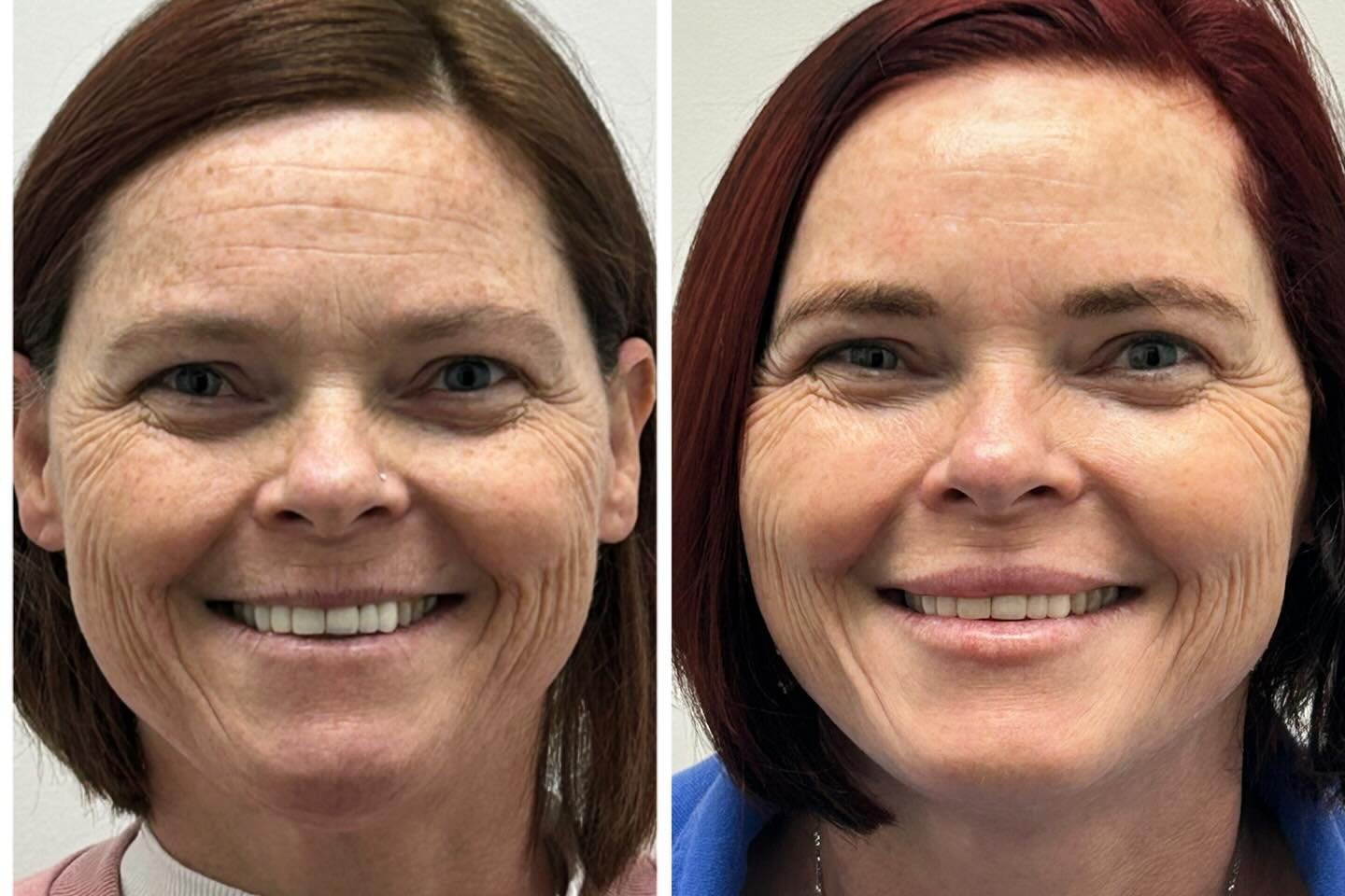 We&rsquo;re are not changing your features, we&rsquo;re refining them! Rewinding time with results that still look like you.✨

#filler #dysport #medspa