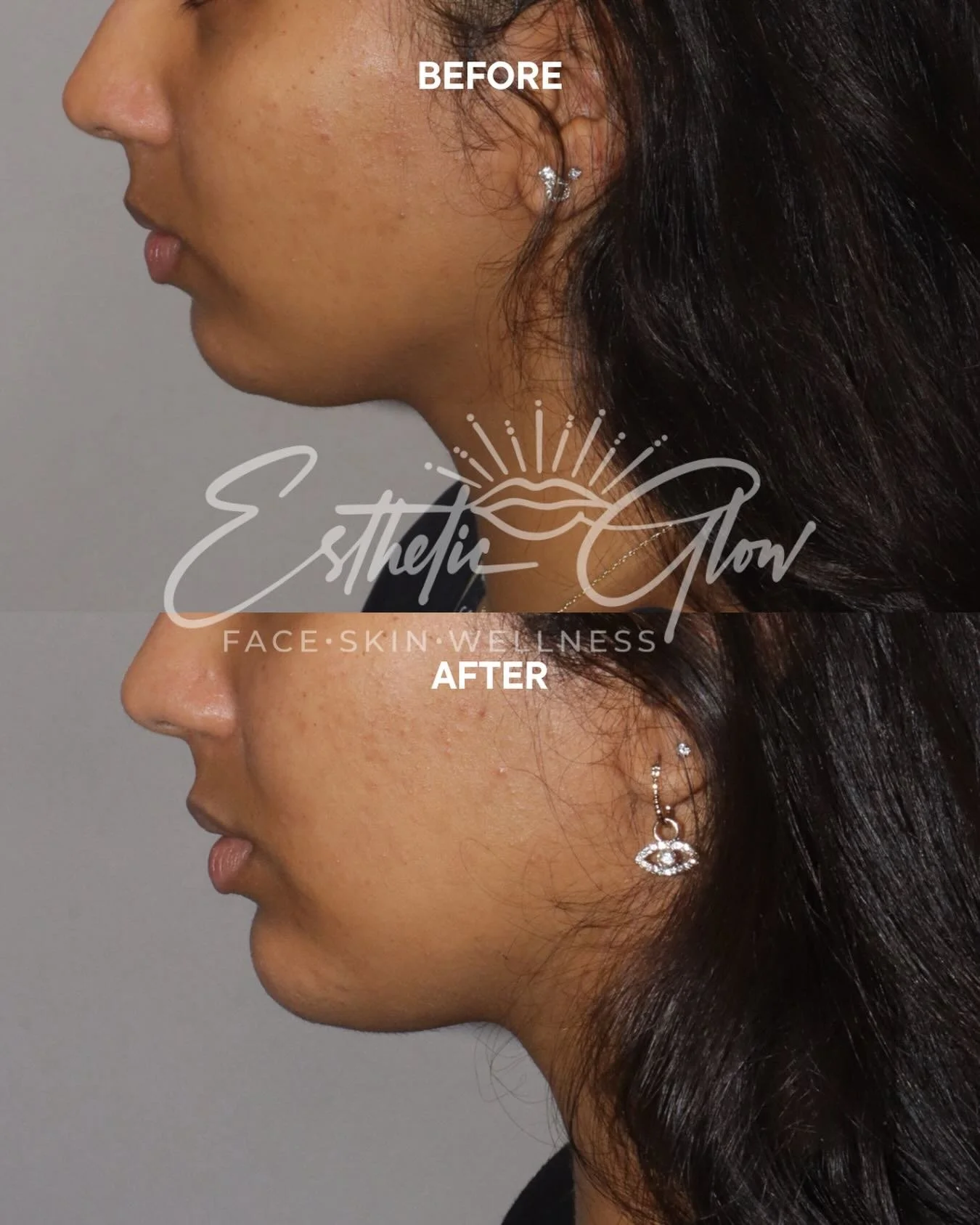 It&rsquo;s amazing what 1 syringe of chin filler can do! #filler #chinfiller #injectables