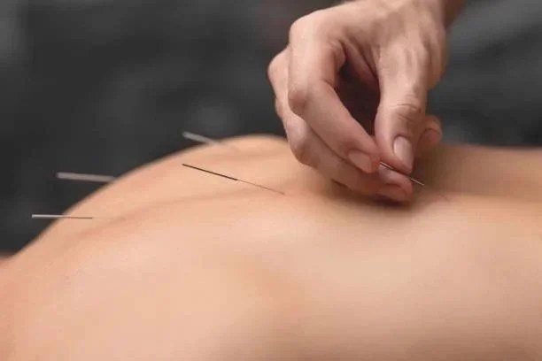 acupuncture