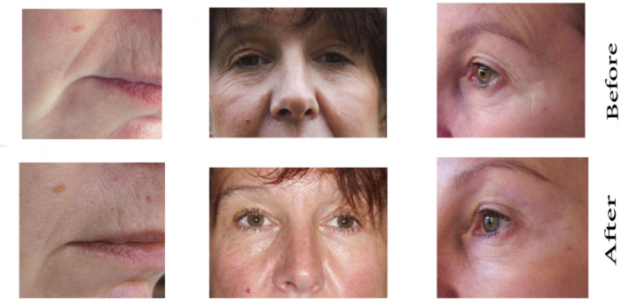 Cosmetic Acupuncture Dublin