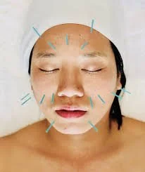 Cosmetic Acupuncture in Grand Rapids, Michigan: Natural, Regenerative Facial Rejuvenation