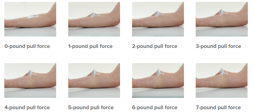 Iv Mechanical Compression IV Complications — Lineus Medical
