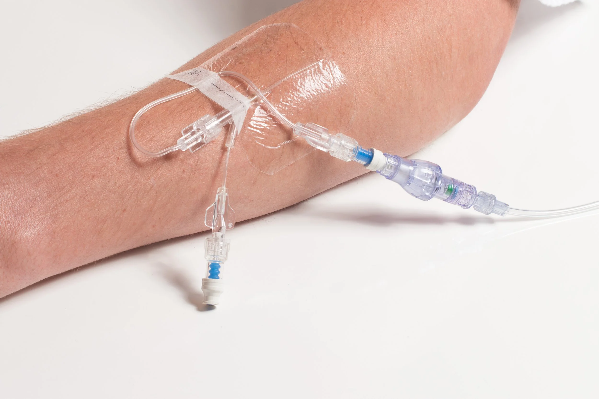 Double Lumen Catheter Procedure Double Lumen Catheter Procedure