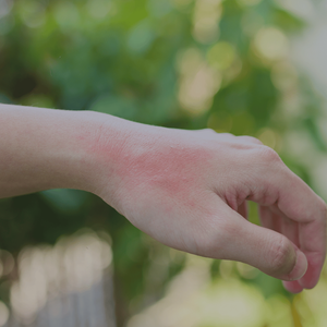 Pumpkin Allergy Rash [And How to Prevent It] — Vegtotable