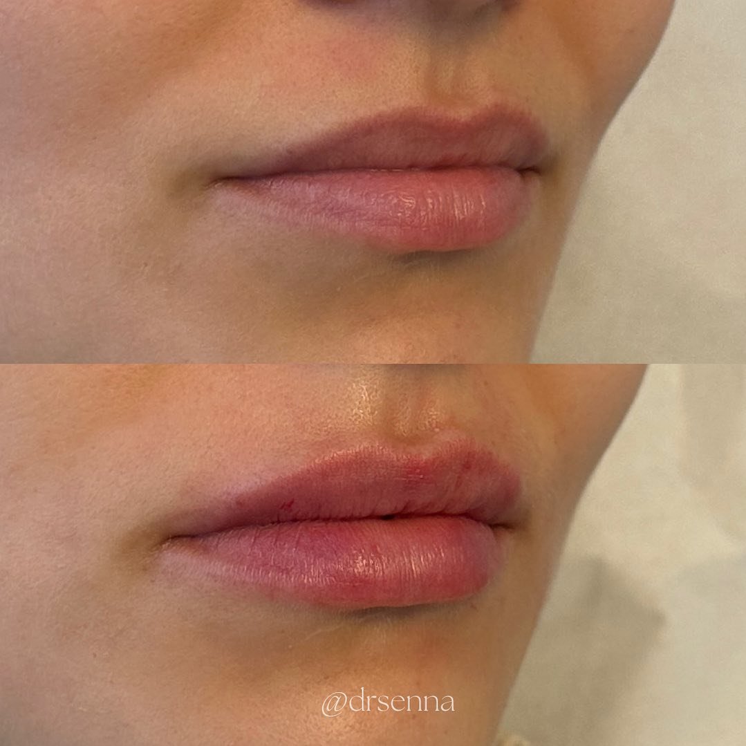 Beautiful lip enhancement for this gorgeous patient. This client had a gorgeous shape to start and wanted a little more plump, so we added some filler to improve her already beautiful shape 😍

Note this was taken straight after the procedure so some