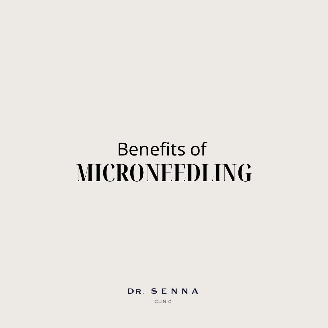 Microneedling is honestly one of the most effective way at improving skin texture and tone! It&rsquo;s a great non-invasive treatment to improve complexion, reduce fine lines and wrinkle and help reduce appearance of pores and scars! It creates micro