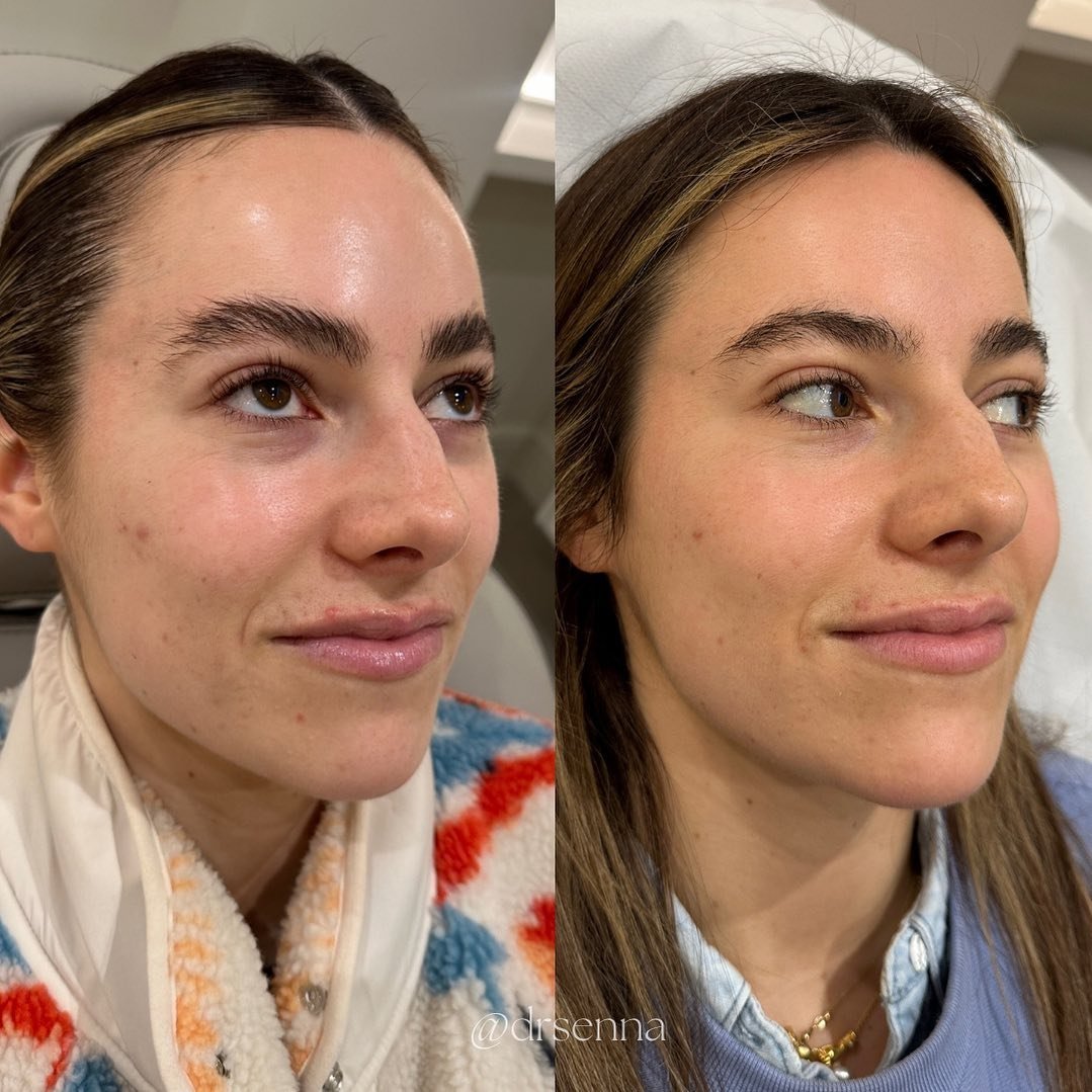 Amazing results after a month of the 1st session of Polynucleotide for the under eyes before the 2nd session and two weeks after microneedling with Meaghan for gorgeous @emzchampion 

She has noticed a big difference with the polynucleotide under the