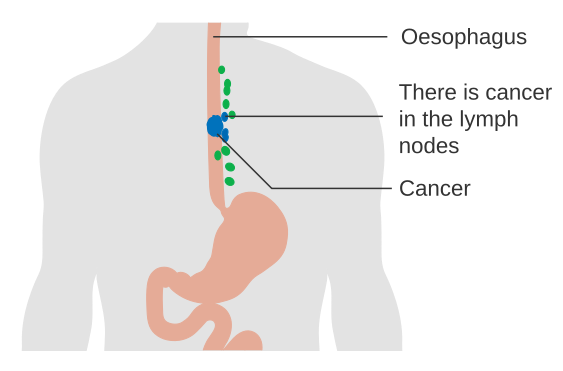 Esophageal Cancer. Diagram illustrating cancer in the esophagus and lymph nodes