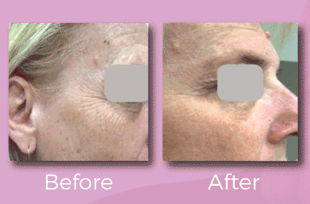 Skin Rejuvenation