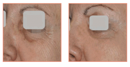Skin Rejuvenation