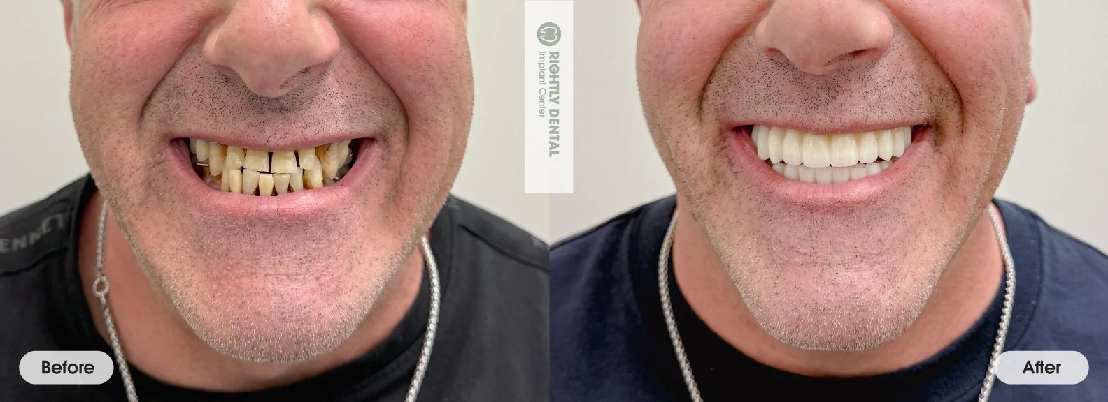Full-arch-implant-All-On-X-Monroe-Orange-County-NY-before-after-man