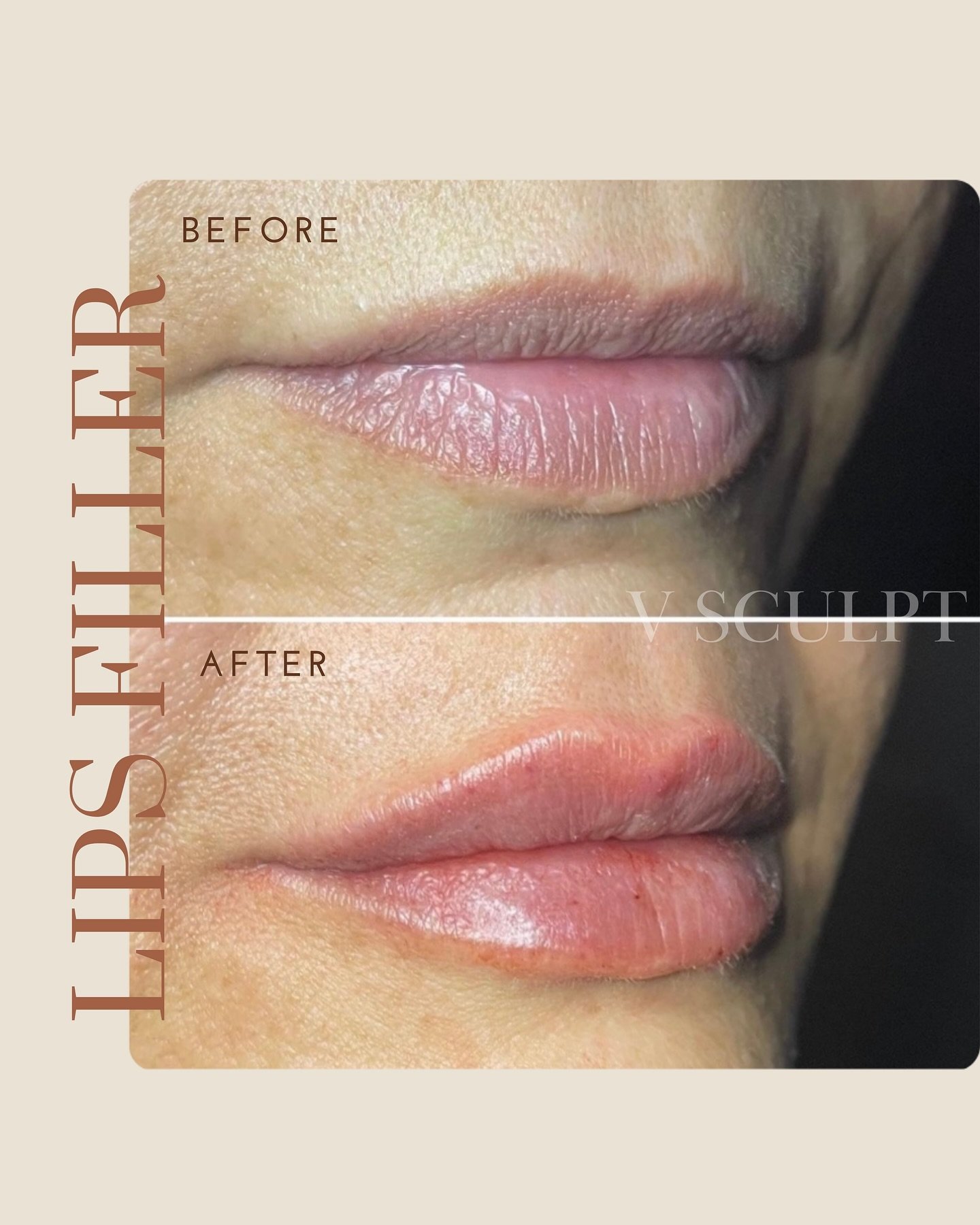 Check out the stunning before and after results and envision the possibilities of having Your lips beautifully transformed✨

#lipfiller #aesthetic #lipinjections #fyp #beautygoals #lipgoals #dreamlips #faceglow #beautytips