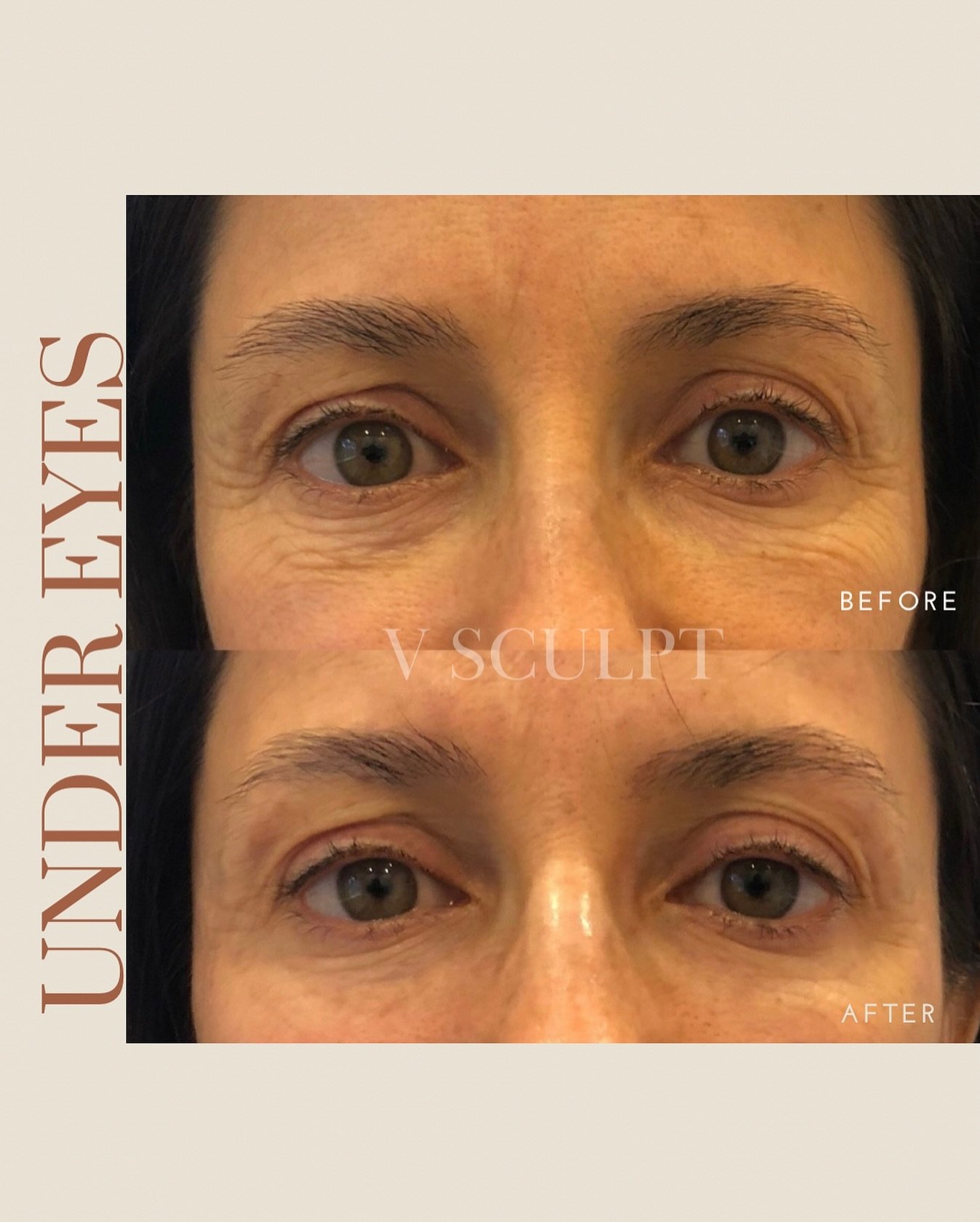 Transform your look with our PRF undereye treatment! 😍✨ See the incredible before and after results for yourself. Book your appointment now for a fresh, rejuvenated look! PRF undereye treatment uses your body&rsquo;s own platelet-rich fibrin to redu