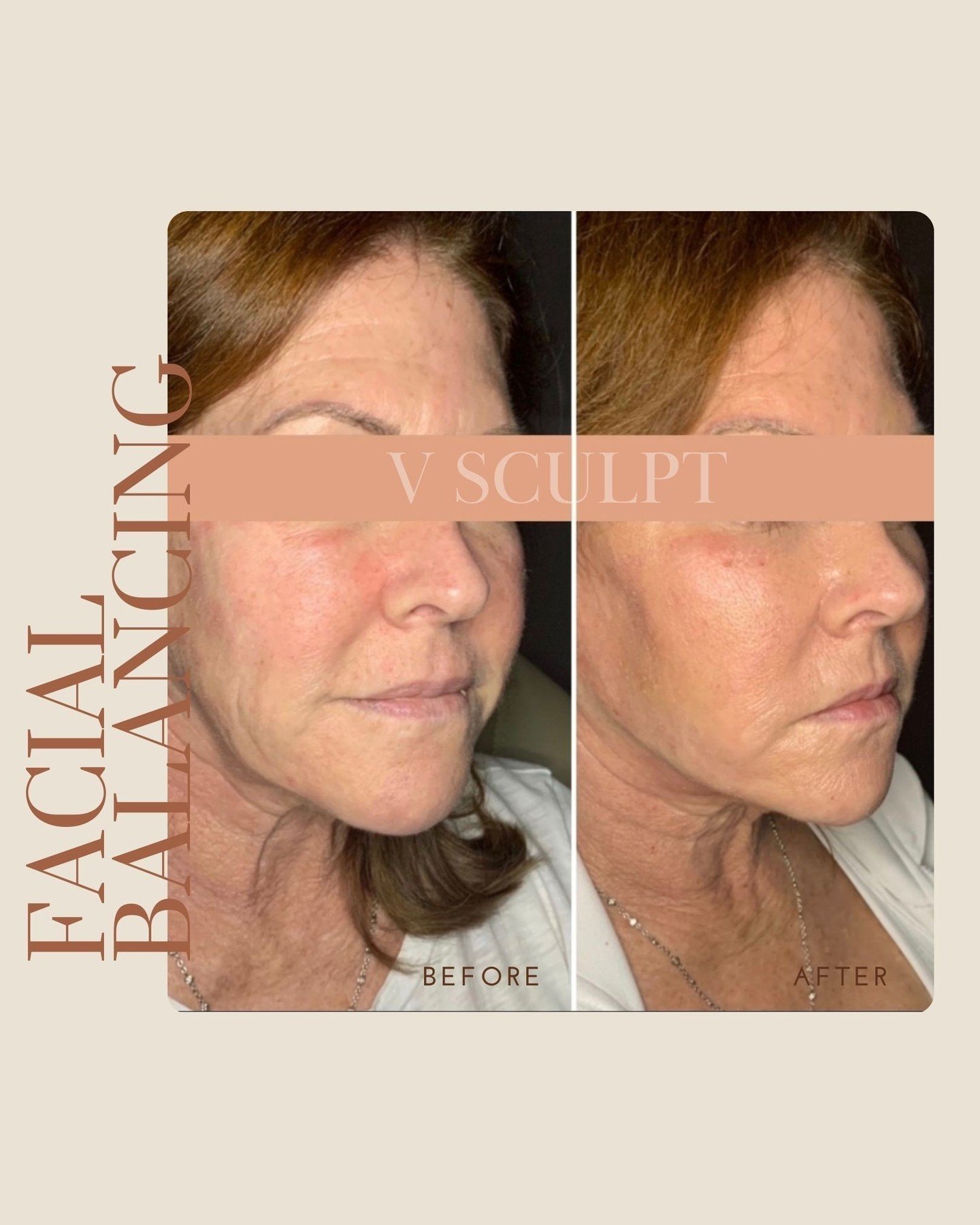 Witness the transformative power of Facial Balancing! From subtle enhancements to harmonious symmetry, our patient's journey speaks volumes. At VSculpt Aesthetics, we believe in celebrating your unique features while achieving balance and radiance. R