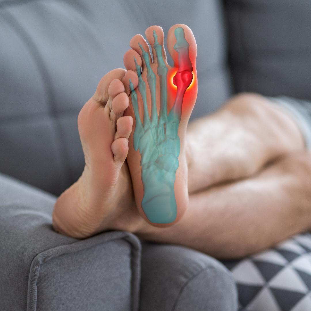Faster Gout Relief: The Role of Ultrasound-Guided Steroid Injections ...