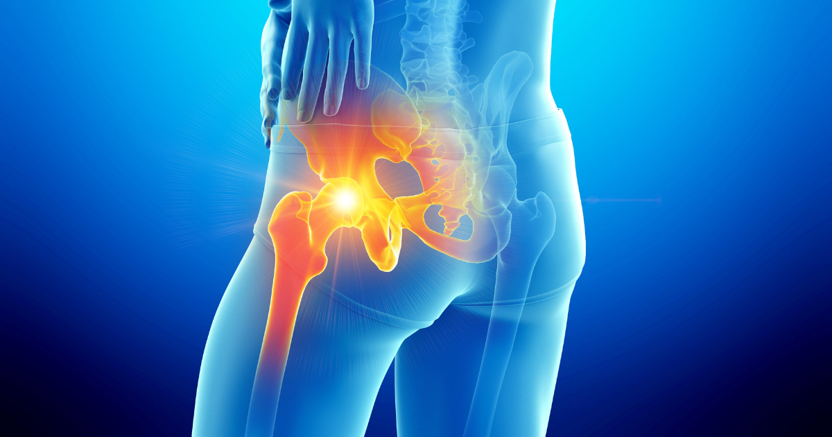 ‘‘How to Treat Hip Pain Caused by Arthritis’’