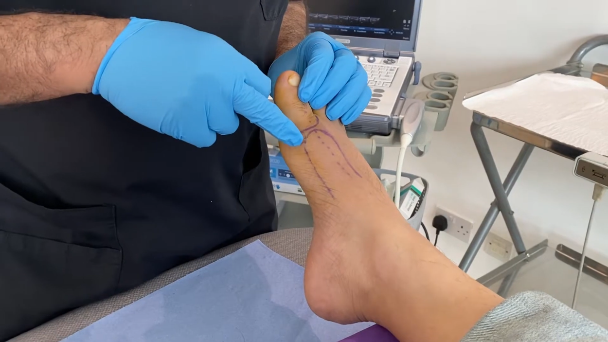 Faster Gout Relief: The Role of Ultrasound-Guided Steroid Injections ...