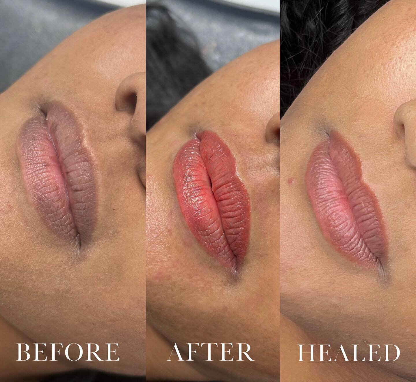 Lip Blush Neutralization after 1 session! I am so happy with these beautiful results so far!! For this client we will require 1-2 more sessions in order to lighten the lips even more and give her the pinky tones she wants!! We will definitely continu