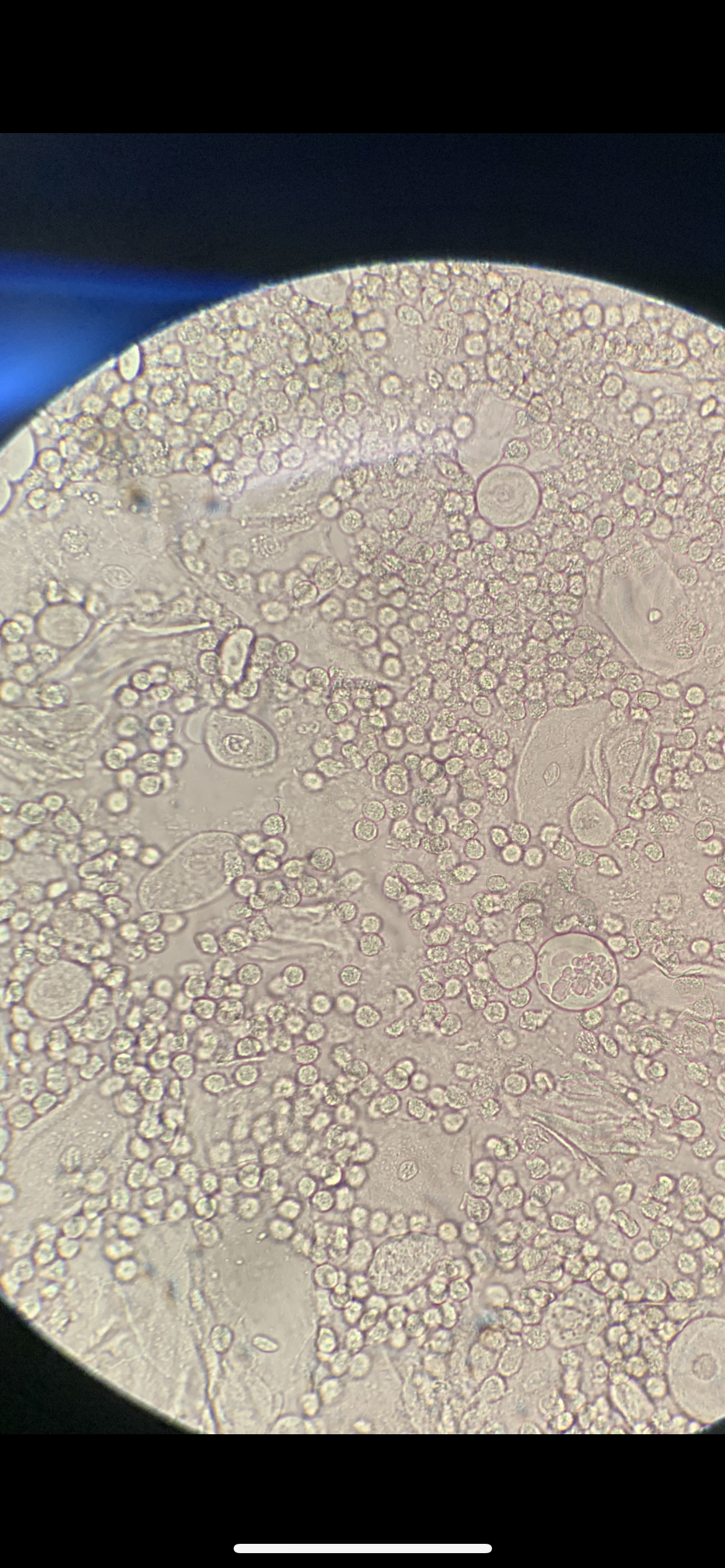 Copious white blood cells; mix of normal epithelial cells and parabasal cells