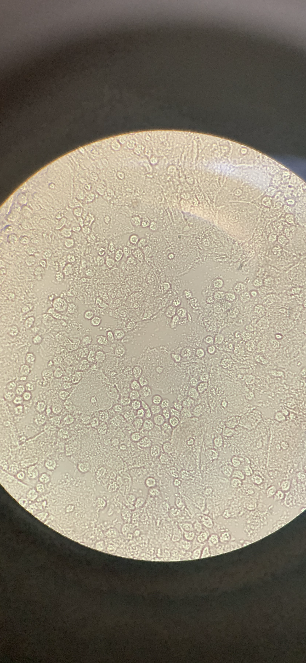 Copious white blood cells; mix of normal epithelial cells and clue cells