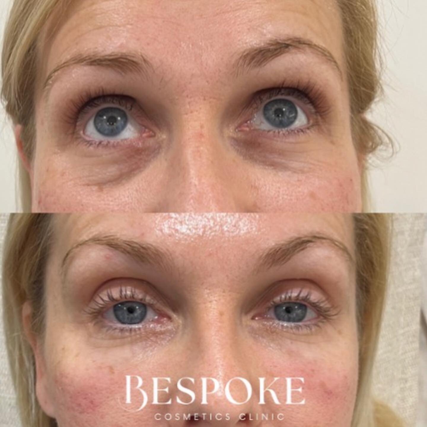 Feeling like you look tired allll the time? We might be able to help! Book a complimentary consultation to see how we can help you! 

All treatments carry risk and require consultation. Our clinic offers consultations on how to improve the under eye 