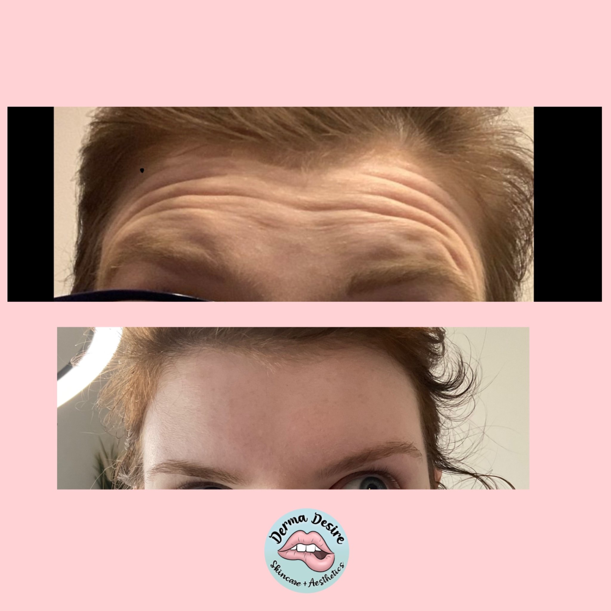 Anti-Wrinkle Treatment - Forehead