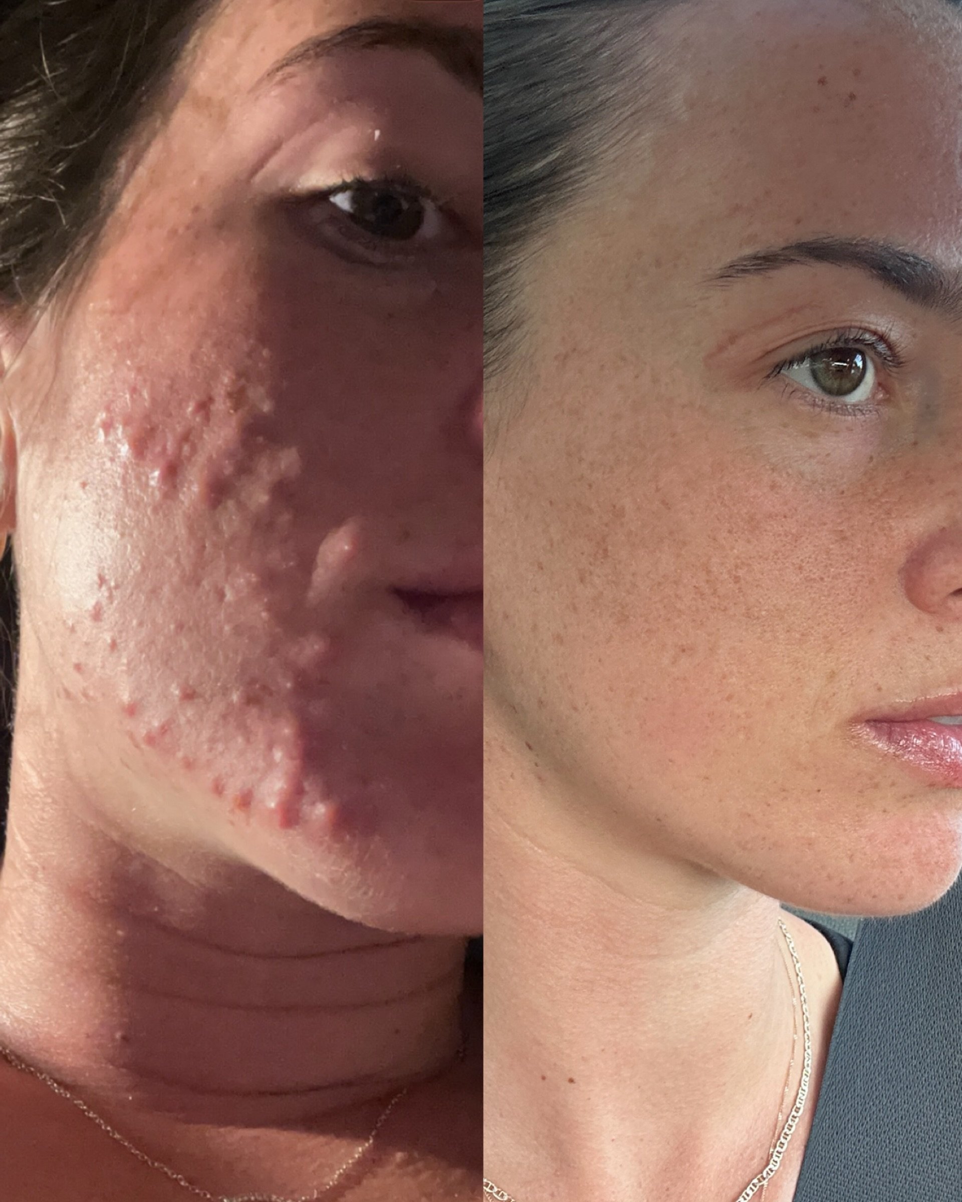 Another wonderful update today from one of our Skin Health Society members who has gone from cystic acne to glowing skin! 

&ldquo;Hey Shauna, hope your trip was amazing!! Just having one of those holy shit my skin has come so far moments!! This is a