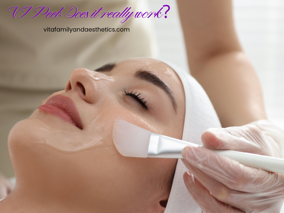 Does a VI Peel Really Work? Here's What You Can Expect