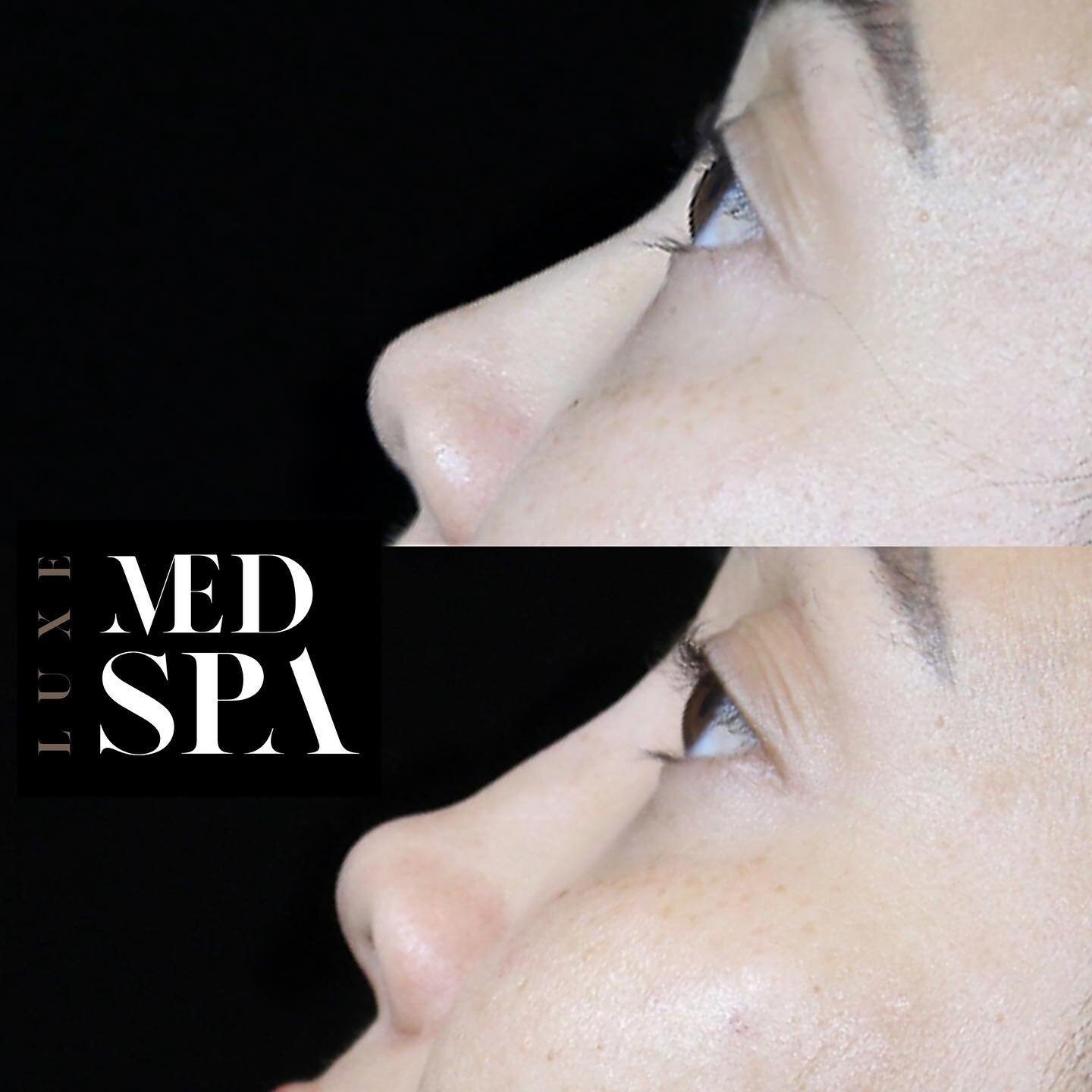 Are you unhappy with the shape or size of your nose? Do you want to enhance your facial features and boost your confidence? Look no further than Luxe Med Spa Aesthetics in downtown Orlando! Our liquid rhinoplasty procedure is the perfect solution for