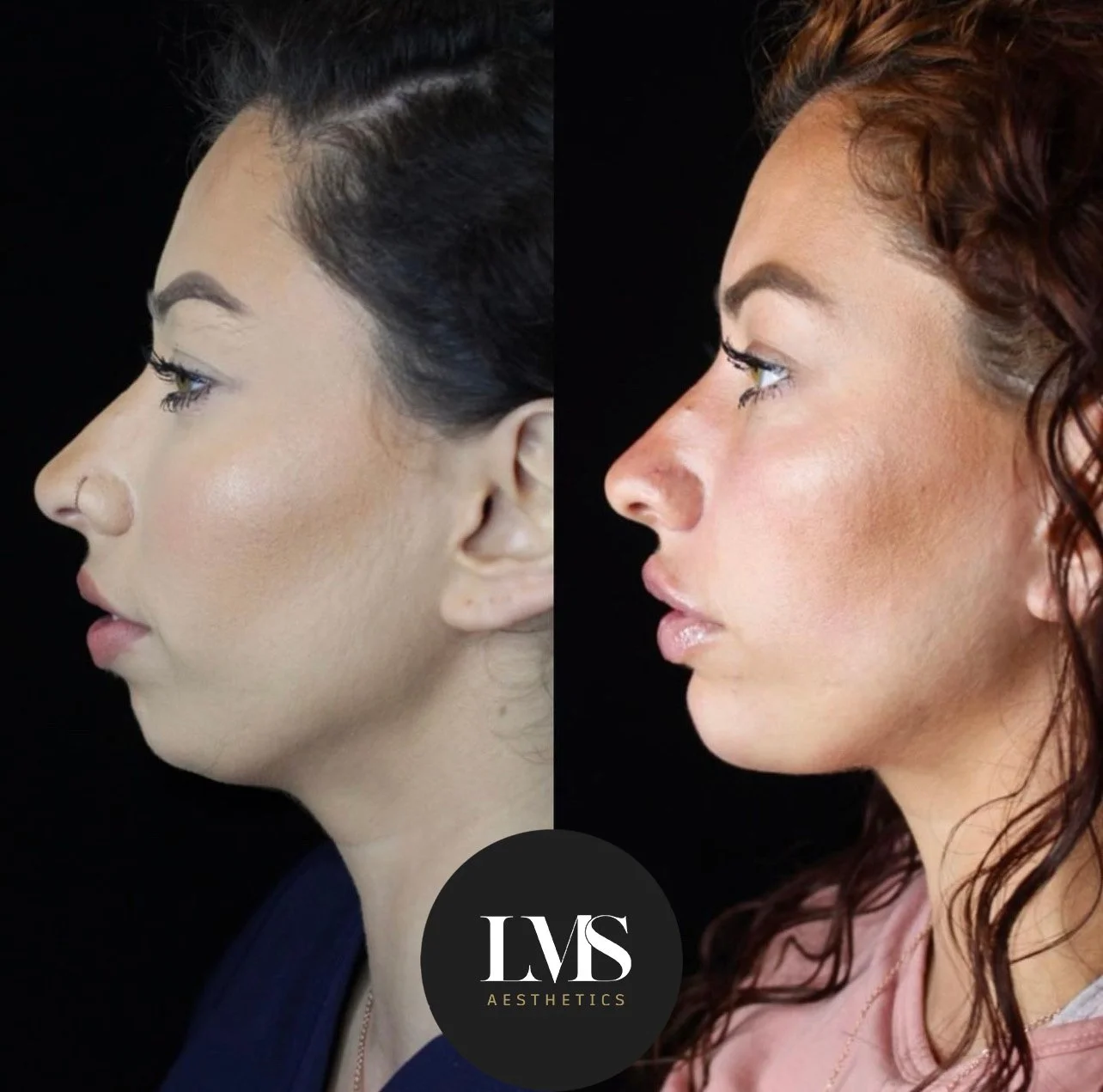 LOWER FACE Medical Spa Orlando Florida