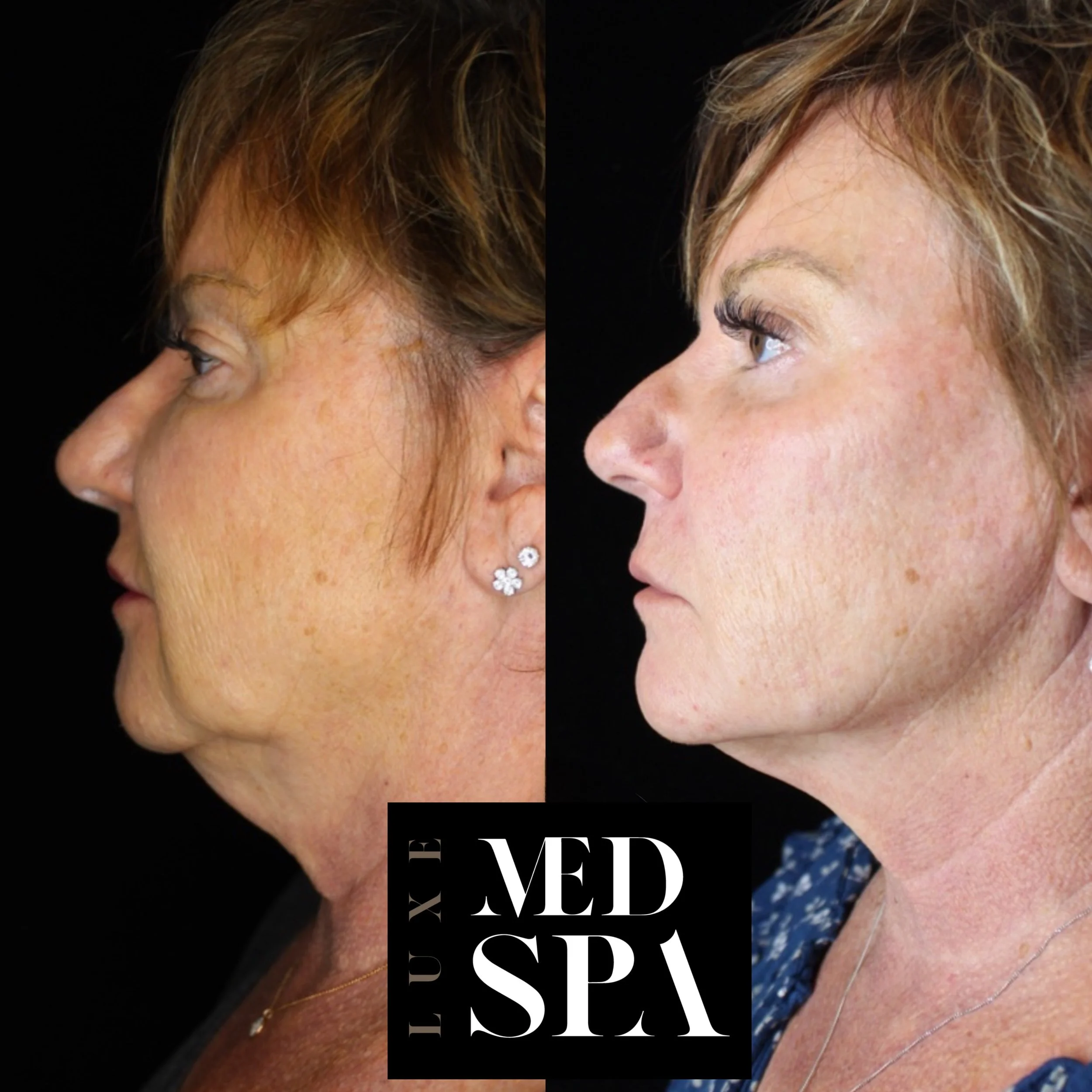 FULL FACE REJUVINATION Orlando Florida