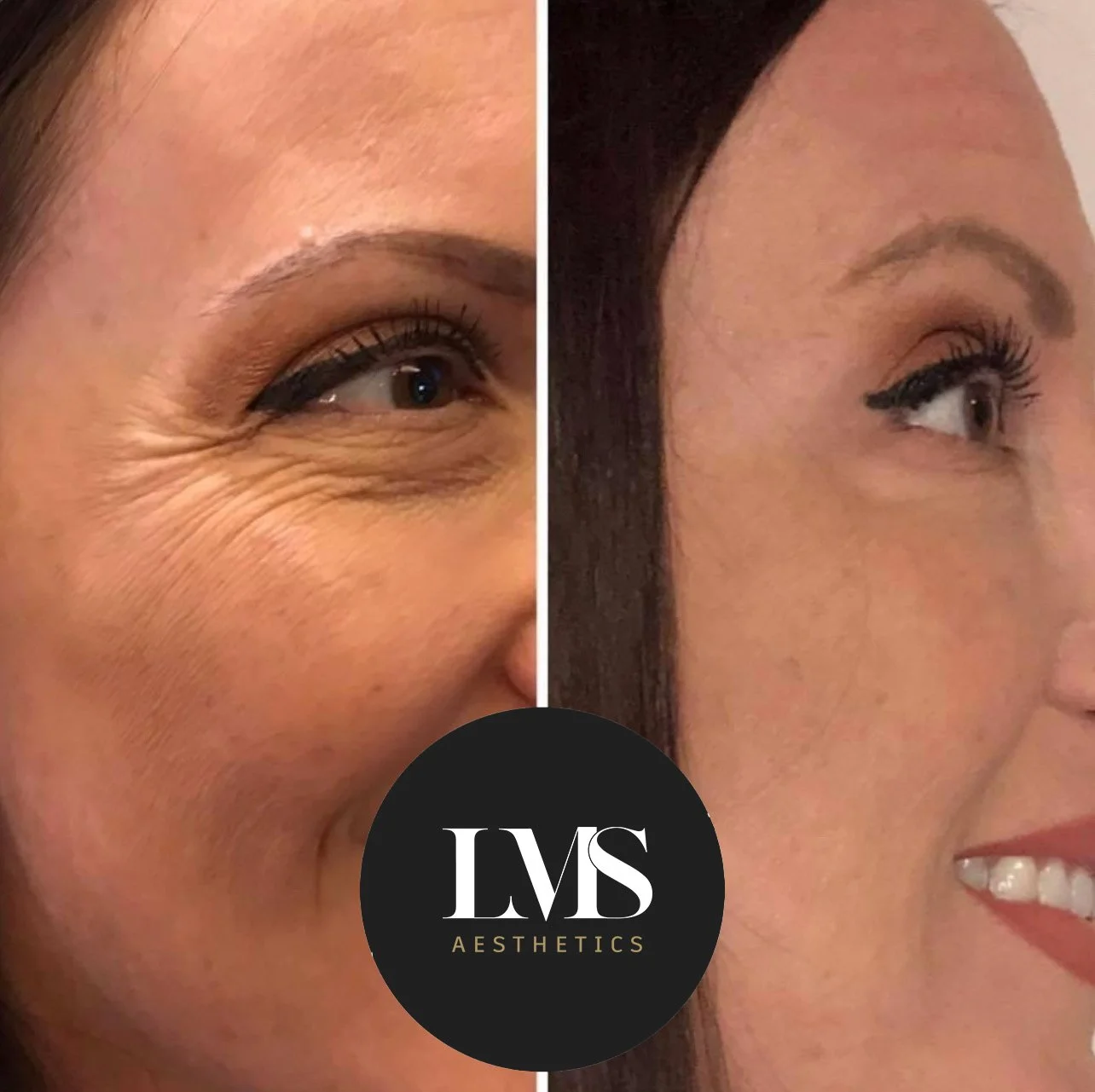 Fillers Orlando florida