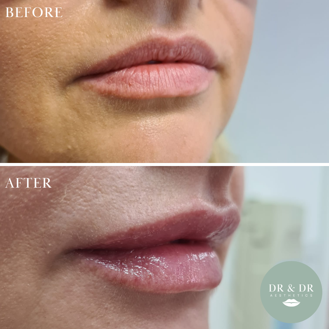 Close-up of lips showing before and after cosmetic lip enhancement, with the after image featuring fuller, glossed lips.