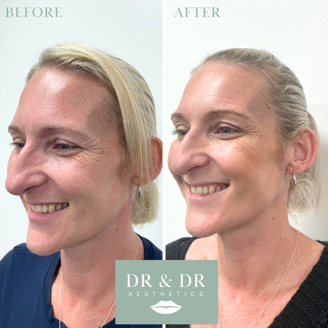 Before and after photos of a woman showing facial improvements, with the before image on the left and the after image on the right, under the label 'DR & DR AESTHETICS'