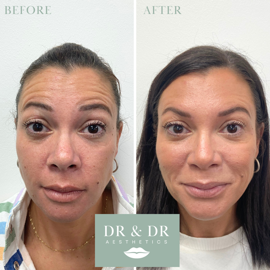 Before and after images showing a woman's face, with smoother skin and improved complexion in the after photo, indicating a cosmetic or skincare treatment.