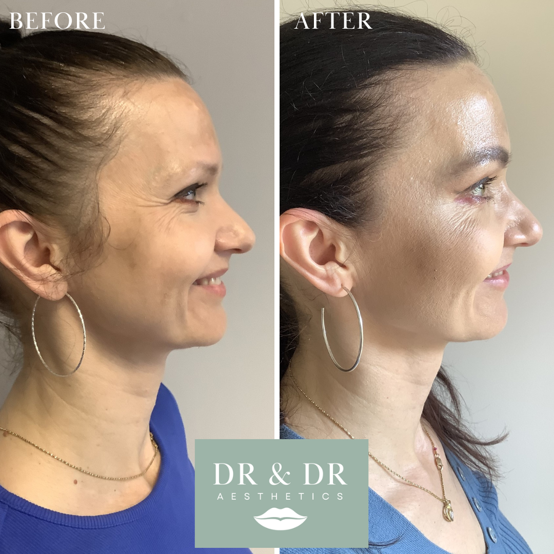 Side-by-side comparison photo showing a woman's profile before and after a cosmetic treatment. The 'before' image shows her with visible signs of aging and skin imperfections, while the 'after' image shows her with smoother, clearer skin. The woman i